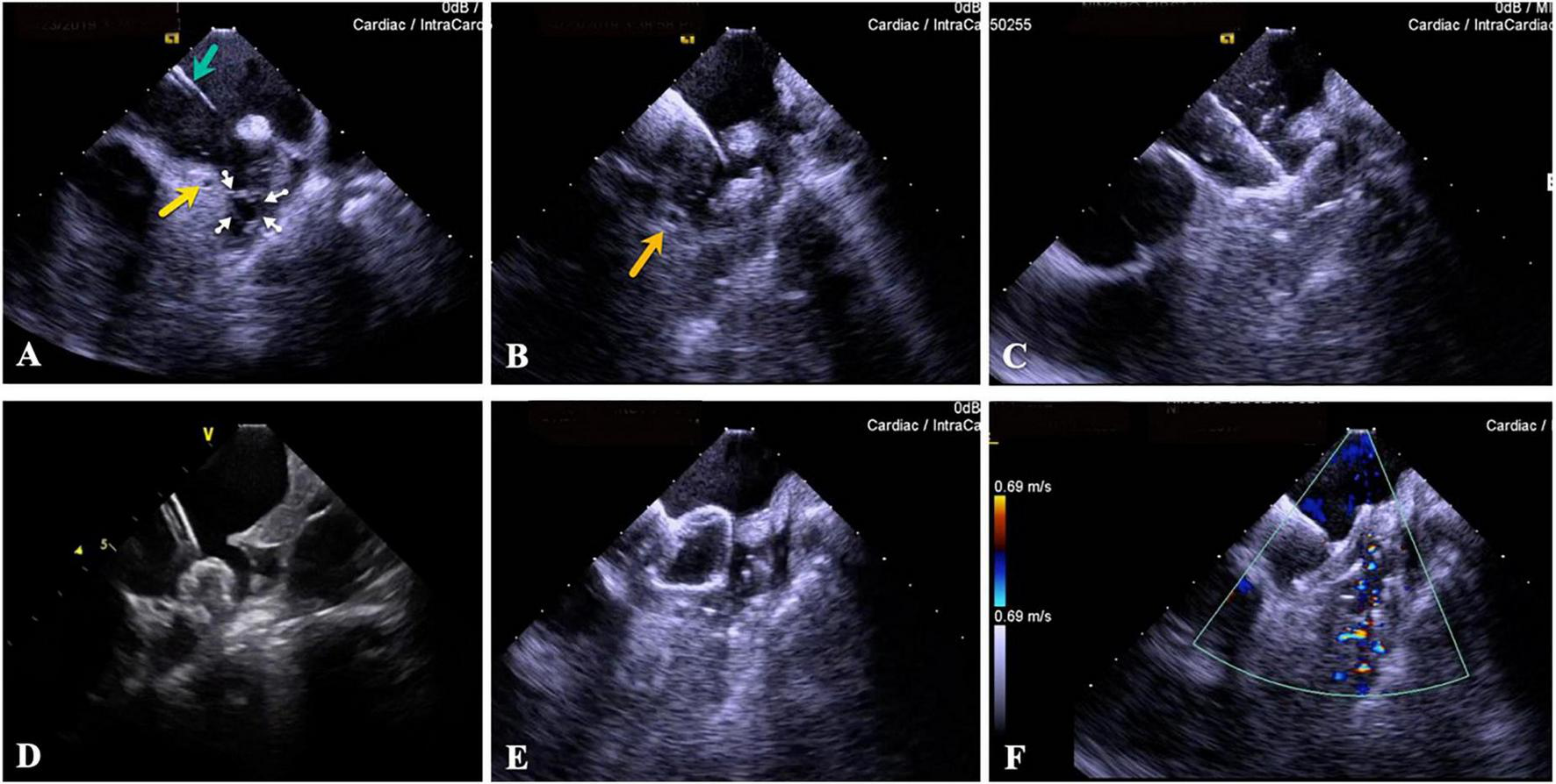 Frontiers | Intracardiac echocardiography Chinese expert consensus