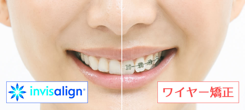 マウスピース型矯正装置(インビザライン) | 千葉県柏市で歯列矯正なら