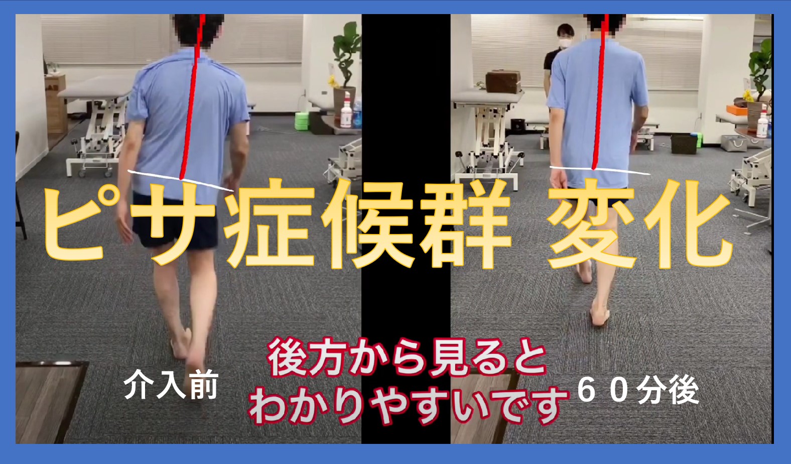 2021年最新】パーキンソン病の姿勢変形のリハビリ！ ピサ症候群と前屈