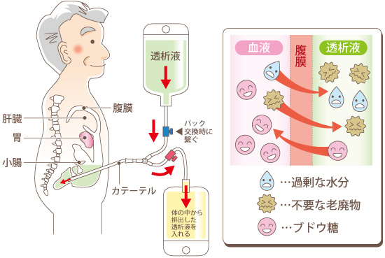 透析療法-腹膜透析｜東京女子医科大学病院 腎臓内科