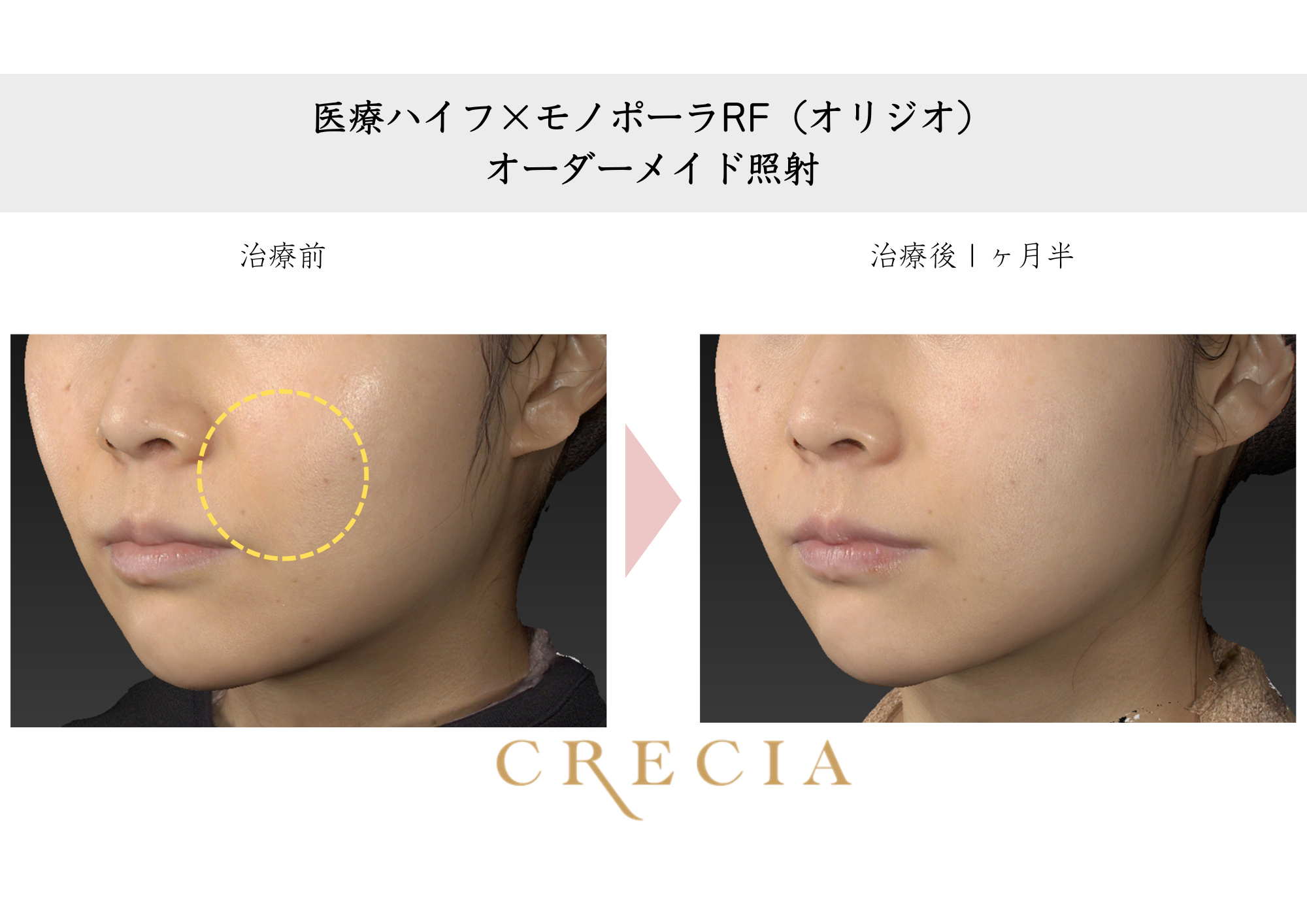 医療HIFU（ハイフ） | 葛飾区の美容皮膚科：クレシアスキンケアクリニック