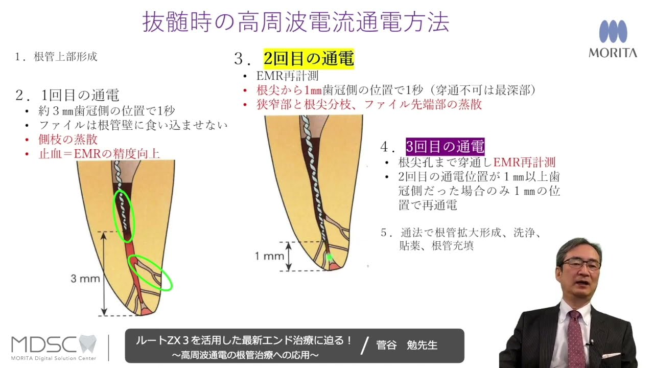 モリタ】抜髄と穿通不可能な根尖性歯周炎への応用 | 菅谷勉 先生
