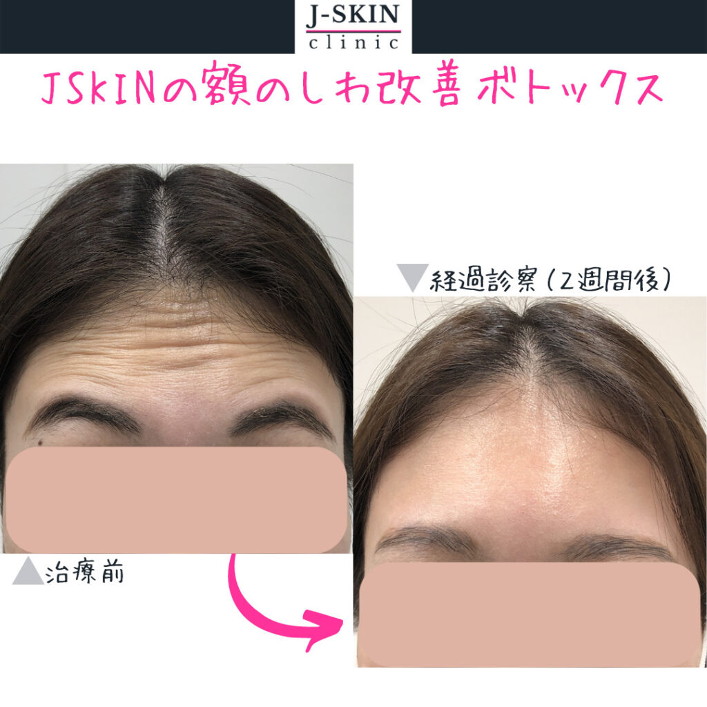 額/おでこのシワを改善するボトックス 特徴や注意点について解説します
