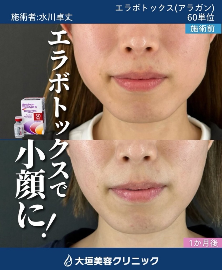 ボトックス｜岐阜・大垣市の美容皮膚科｜大垣美容クリニック（アクア