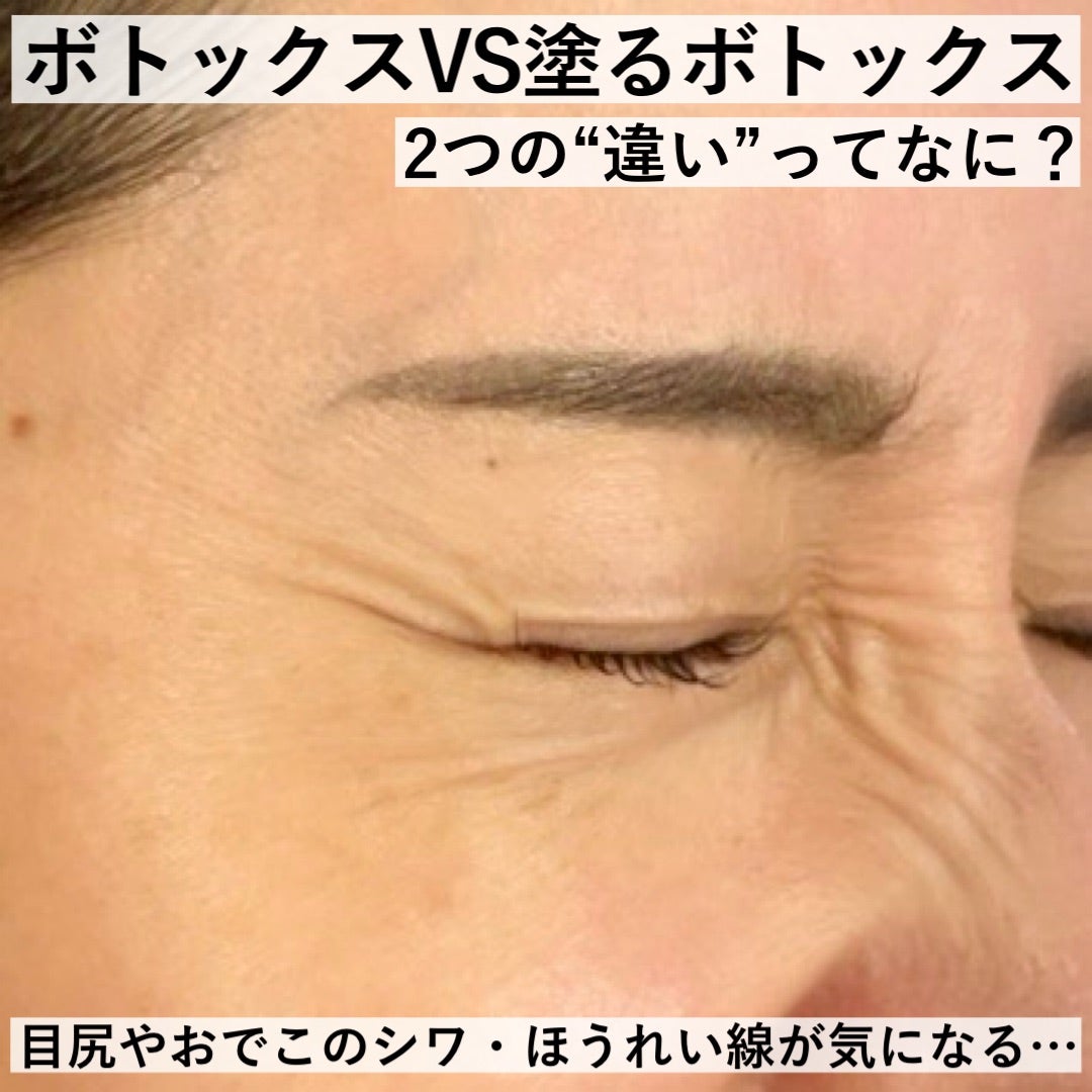 目元や額のシワ・ほうれい線】ボトックス注射と塗るボトックスの違いっ